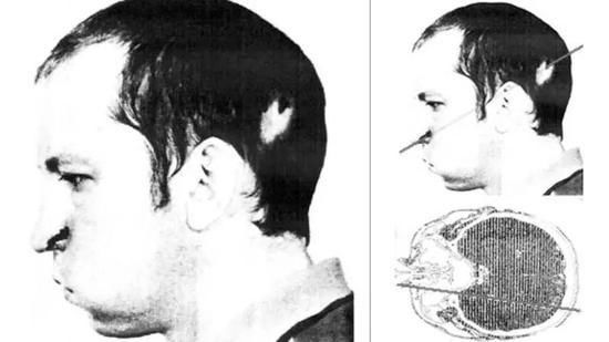 被高能粒子束爆头后还活着的科学家：智力完好