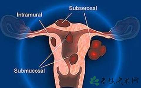 子宫肌瘤能吃阿胶吗