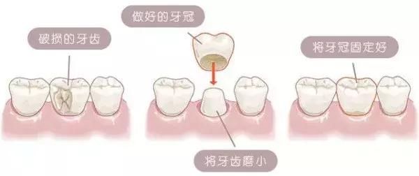 为什么明星都爱做烤瓷牙?