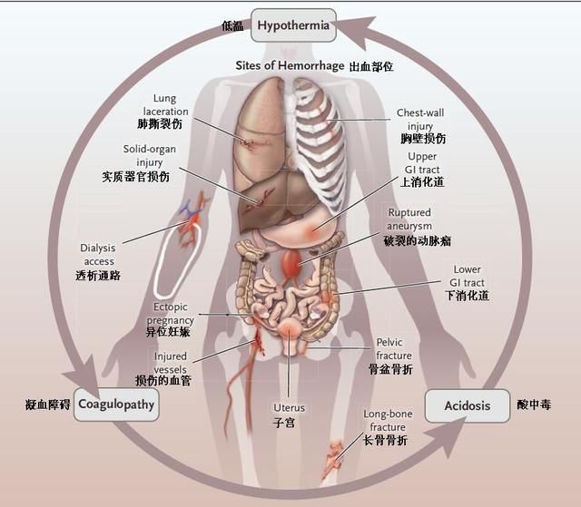 NEJM最新综述：失血性休克