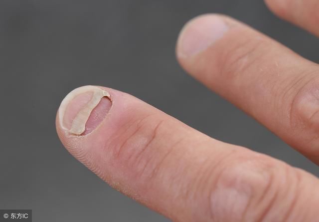 治疗指甲的方法修复受损甲床清除鲜菌