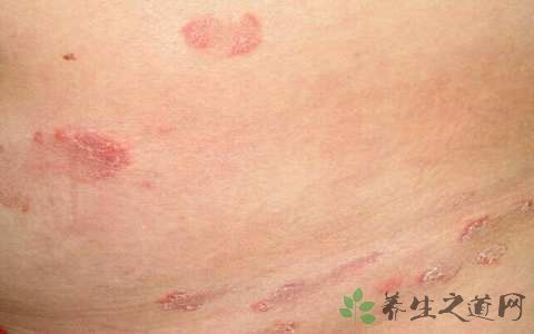 梅毒抗体阳性可以母乳吗