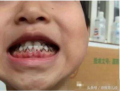 宝宝牙齿上的黑斑你以为仅是蛀牙吗?!