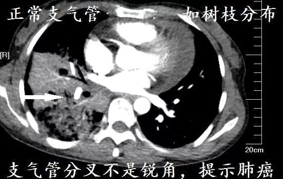 肺CT也会装酷:如何从CT上看出肺癌的病理类型?