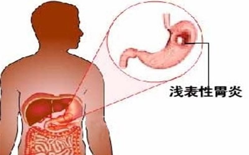 浅表性胃炎有哪些症状?不治会有哪些危害?浅