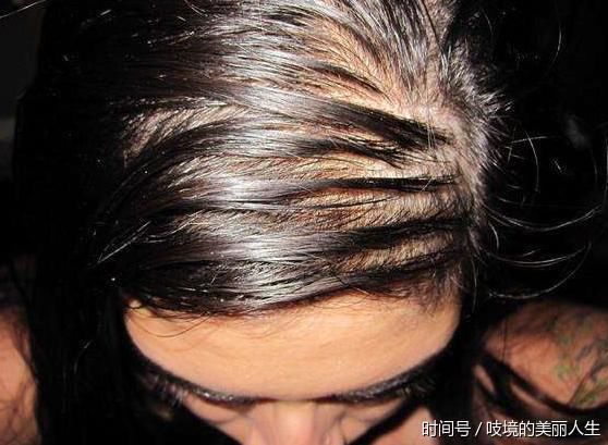 把头皮上堵着毛囊的螨虫排出,头油、掉发就好