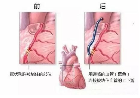 冠心病患者,哪些适合搭桥手术,搭桥和支架又该