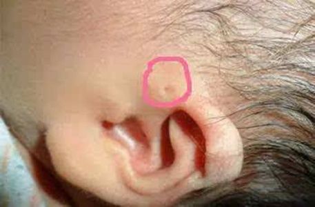 孩子一个耳朵