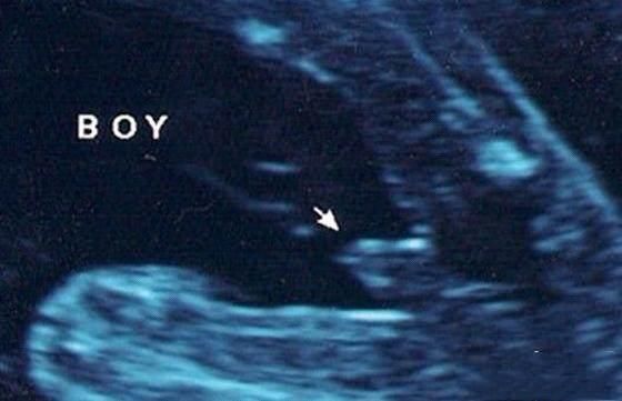 四维单子上有男女暗示 彩超怎么看男女其实有