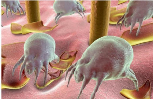 脱发、头发油、头皮屑多可能是螨虫在作怪,用