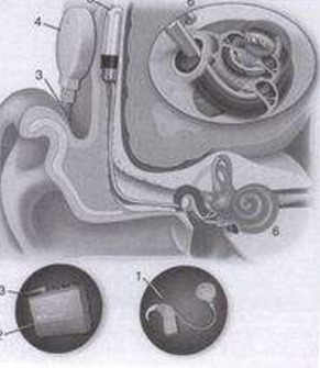 人工耳蜗能用多久