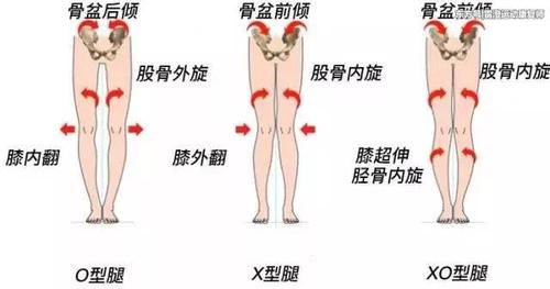 腿不直怎么办?XO型腿怎么变回双11女神