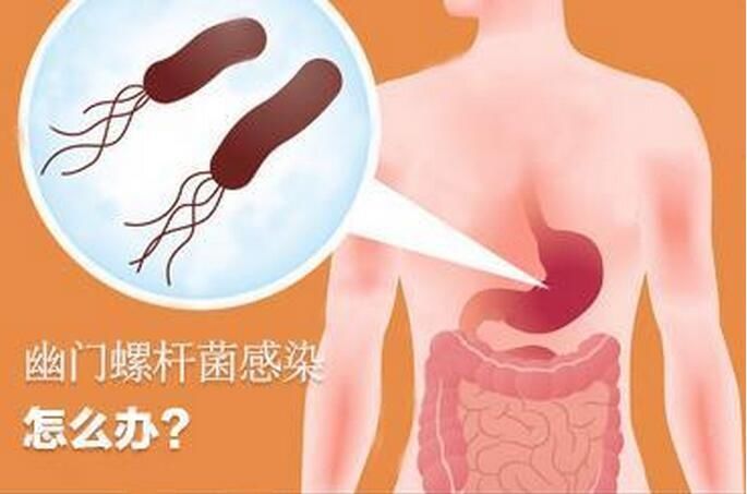 如果没有幽门螺旋杆菌感染,至少有一半的胃癌