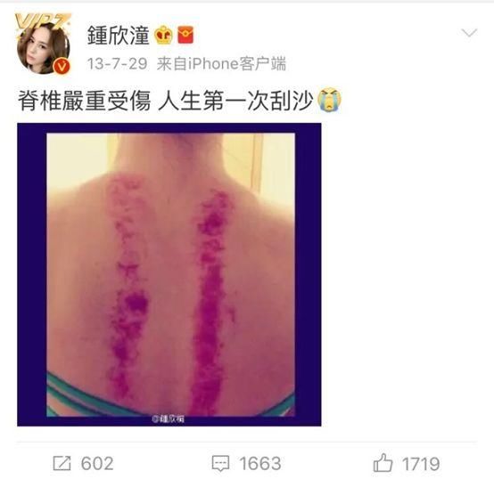 阿娇晒刮痧照吓瘫网友…“像被烧伤了”!