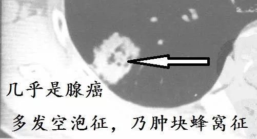 肺CT也会装酷:如何从CT上看出肺癌的病理类型?