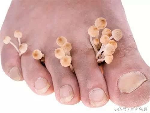 脚后跟干裂脱皮是怎么回事儿?送你几个嫩足小妙方!