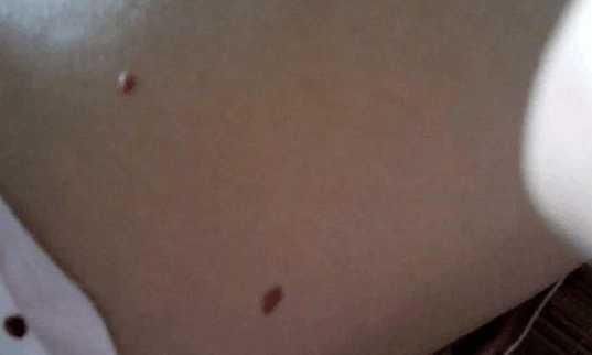 你身上背上是否有出现这些红点红痣,要是有就