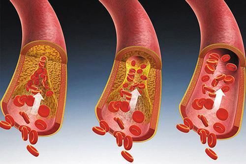 出现这4个信号，暗示你的血脂已经很高了，赶紧降血脂