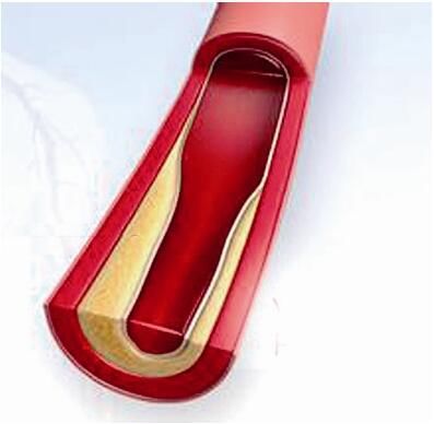 甘油三酯久高不下,一爆发就是大事件,血脂早降