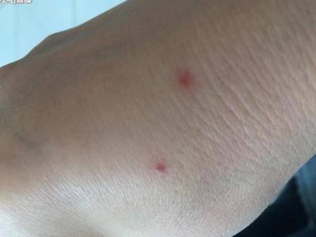 手背和颈部出现红点不痛不痒,要留意,可能是肝