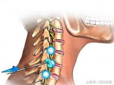 一次按摩让27岁小伙送了命，得了颈椎病到底应该怎么治？