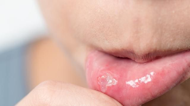 孩子就爱口腔溃疡吃不下?吃这个水果,物美价廉做拉面条图片