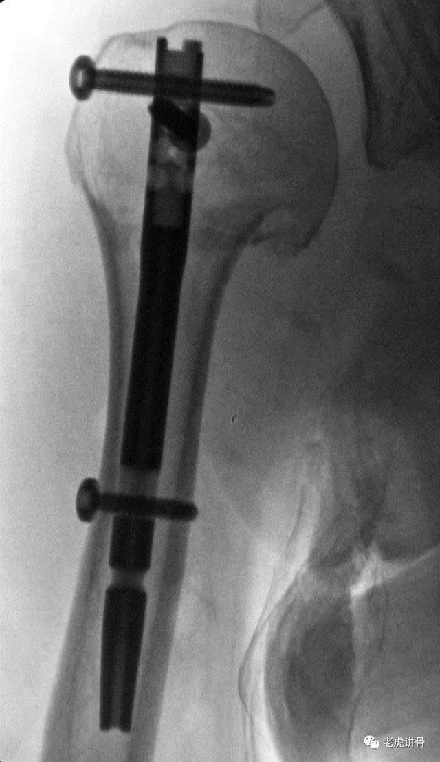 肱骨近端骨折:髓内钉的历史和技术要点