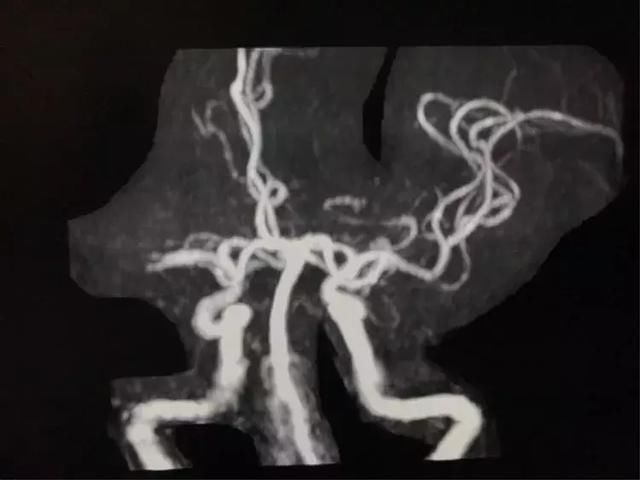 脑血栓机械取栓三例