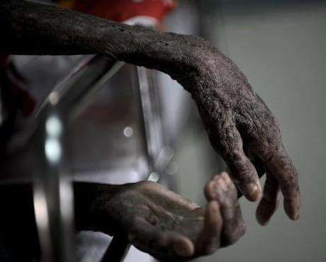 谁来关注黑非洲?快被艾滋病灭绝的可怜黑人