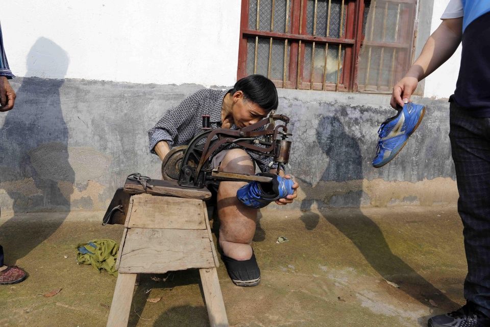 54岁男子双腿肿得像水桶,渴望查出病因