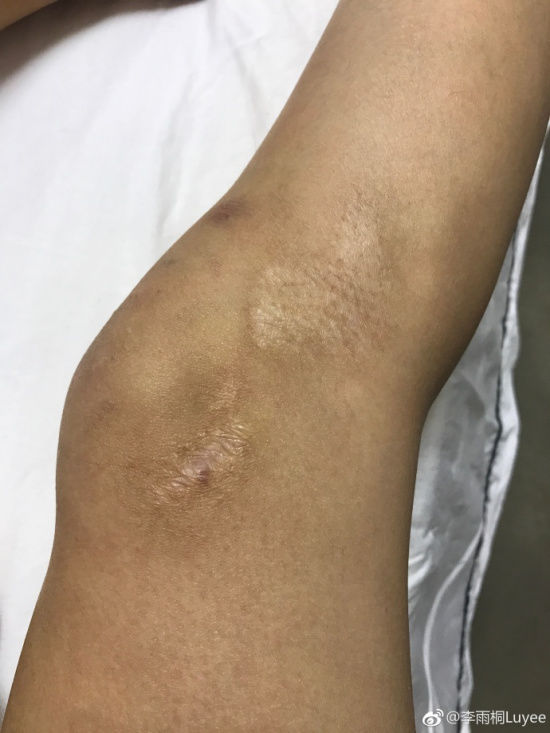 薛之谦出车祸第一时间发新闻稿 李雨桐伤口被