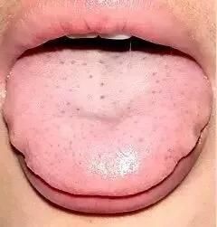 舌头有齿痕怎么办?