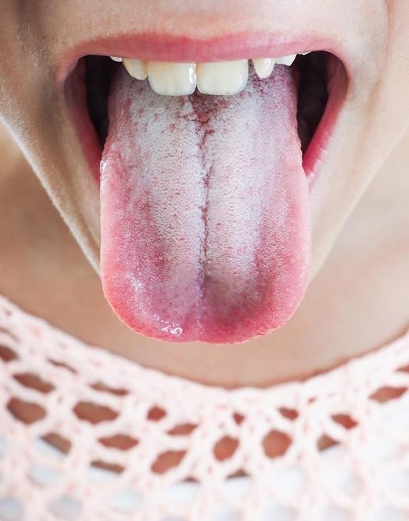 舌苔发白是怎么回事? 这5个调理方法有助于恢