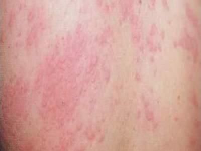 荨麻疹难受?农村一常见植物,治荨麻疹的特效药