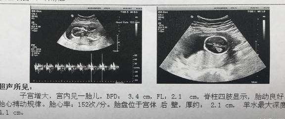 孕期6次彩超全分享: 双顶径、股骨长、胎心率