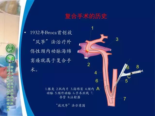 39年前开创“复合手术”，治愈颅底高位颈内动静脉瘘