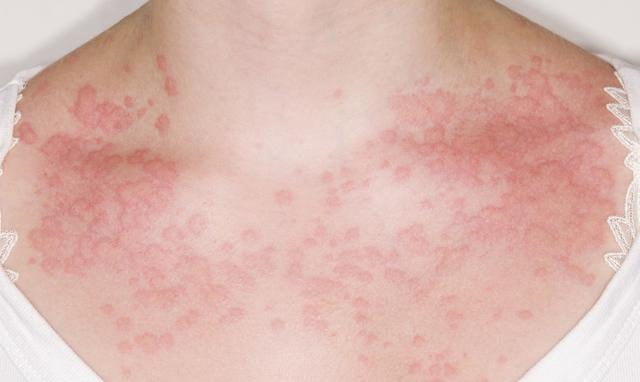 冬季易患寒冷性荨麻疹,这种症状还得治疗!