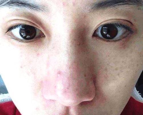 毛孔粗大忍不了,实不相瞒,可能是螨虫躲藏其中