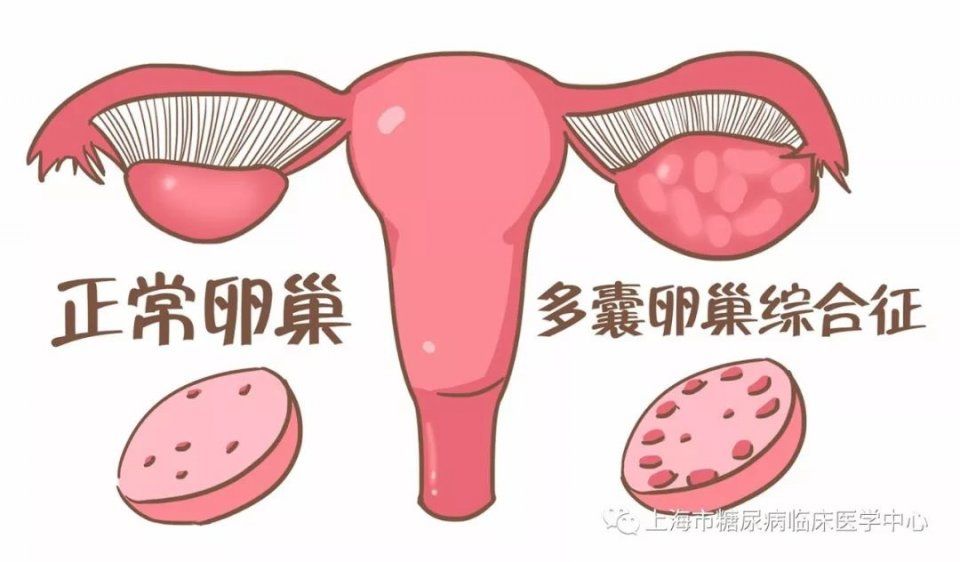 月经失调、不孕、肥胖、痤疮，都跟这种病有关，你知道多少?