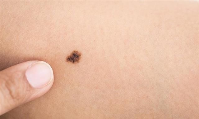 身上的痣,该如何去掉?3个方法,各有所长