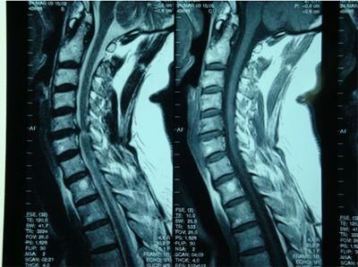 颈椎病到底需要拍X光片,CT还是核磁?