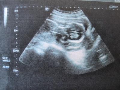 孕妇到医院产检, B超显示的画面医生看后都直
