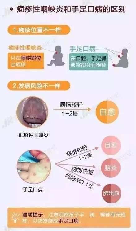 @常州家长:最近疯传的“幼儿疱疹性咽峡炎进入高发期”，究竟是什