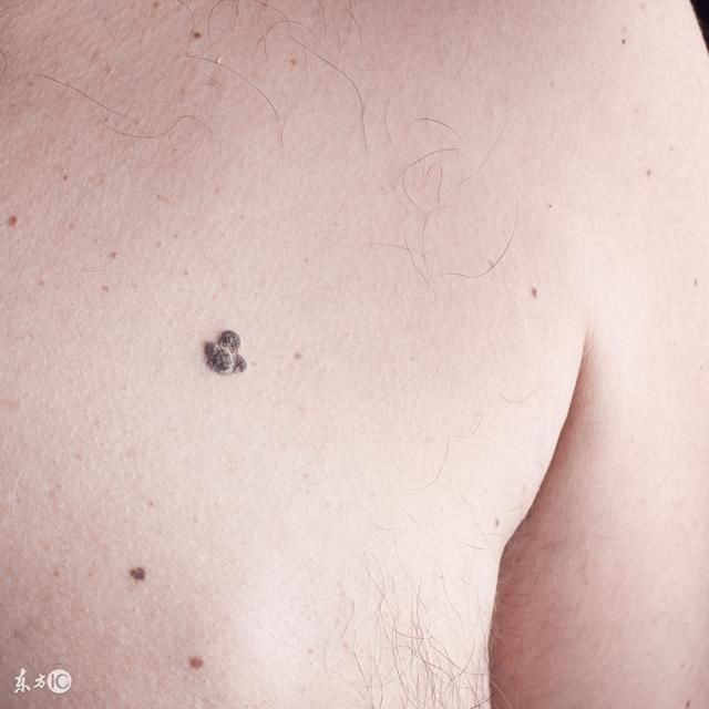 黑色素瘤为什么不属于良性肿瘤