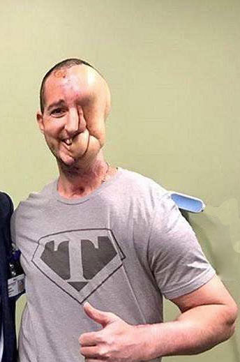 38岁帅哥得怪病整个左脸坏掉,家人看了都心里