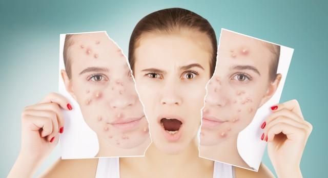 怎样除掉面部螨虫,教你除螨虫最好的方法