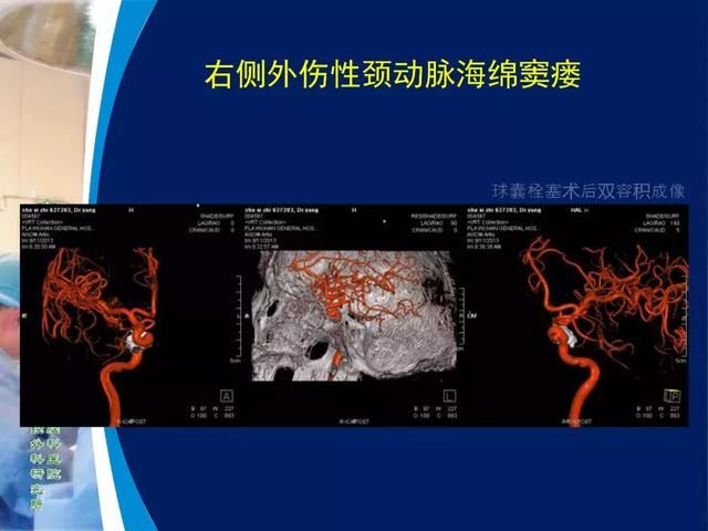 39年前开创“复合手术”，治愈颅底高位颈内动静脉瘘
