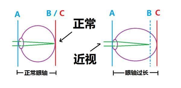 近视真的可以靠肌肉锻炼来恢复视力吗?不要再轻信谣言了