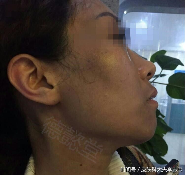 惊!坏情绪也肯引来瑞尔黑变病,学会调节你的情