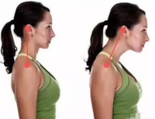 颈椎轻度膨出治疗效果如何?好恢复吗?效果比